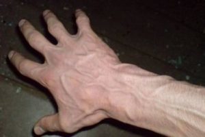 методи за лечение на разширени вени на ръцете