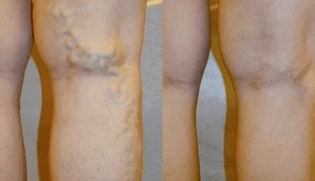 признаци и симптоми на разширени вени по краката при мъжете