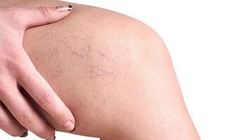 етапи на развитие на разширени вени