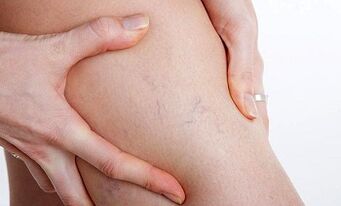 причини за развитието на разширени вени на краката