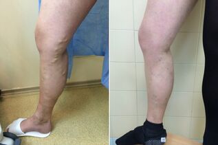 лазерно лечение на разширени вени преди и след снимки
