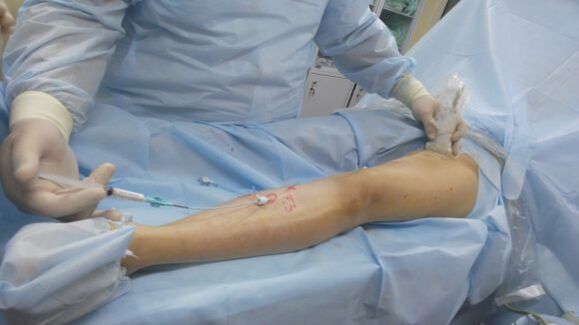 операция при разширени вени по краката