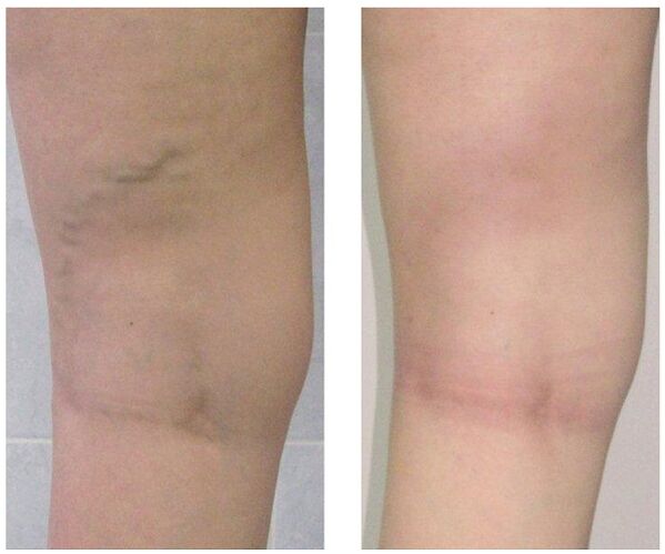 вена в крака преди и след лечение на разширени вени