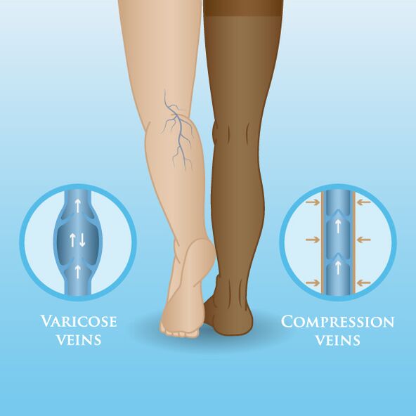 Ефекти на компресионните облекла върху разширените вени на краката