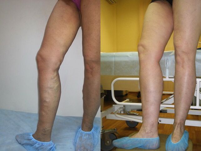 Крака преди и след лазерно лечение на разширени вени