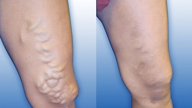 Крака преди и след лечение на тежки разширени вени