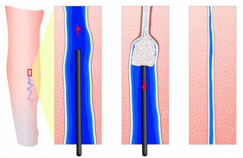 склеротерапия за разширени вени на краката при мъжете